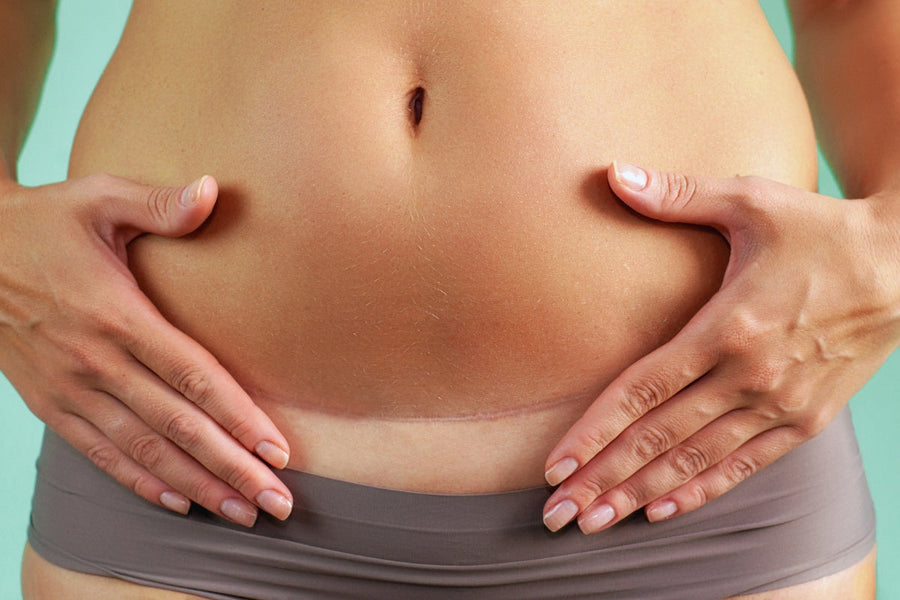 Driving My Car After a C Section: When Is it Safe?