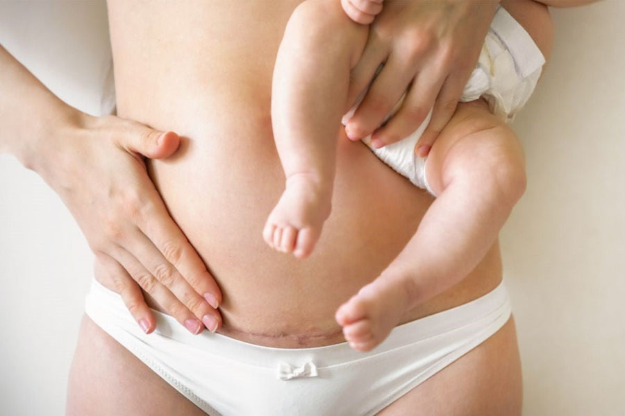 A mother holding her baby while lying in bed, gently touching her c-section scar