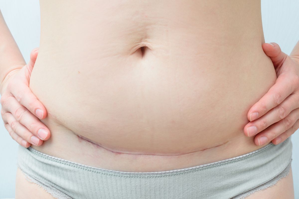 C section overhang explained causes risks solutions