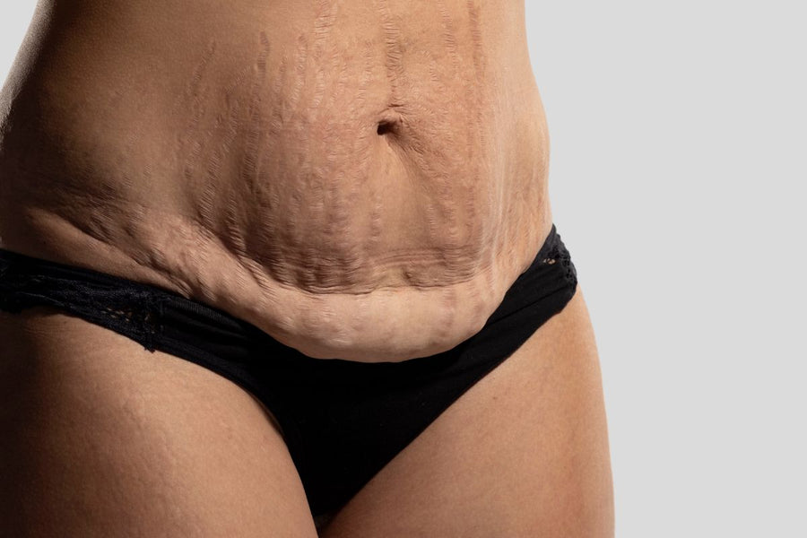 Is C-Section Overhang Permanent? Honest Recovery Timelines from Weeks to 12 Months